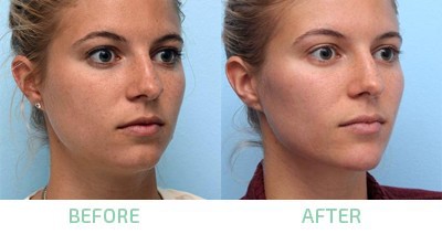 Skin booster with botox
