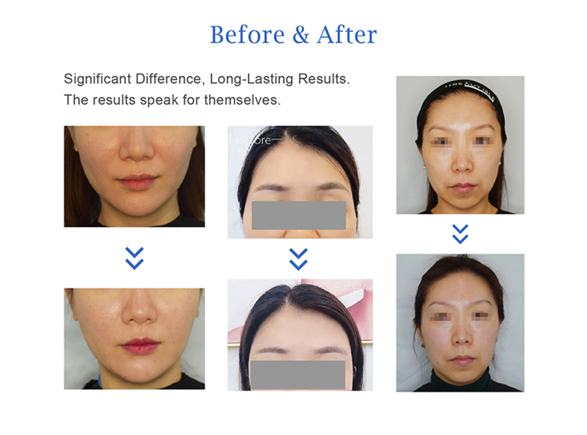 poly-l-lactic acid filler before and after - Dermax