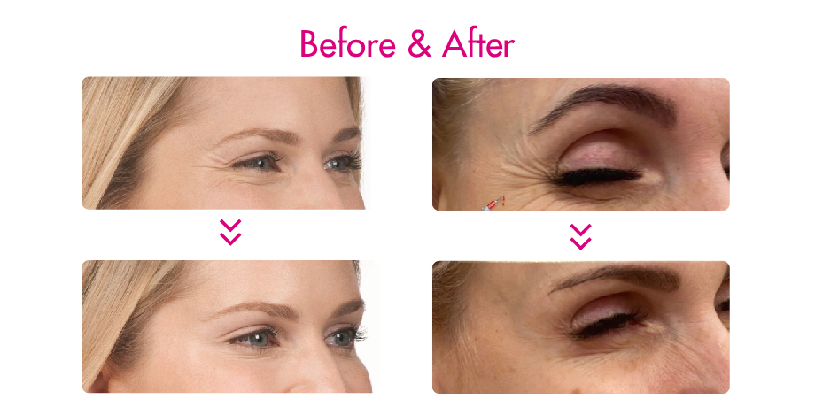 botulinum toxin injections