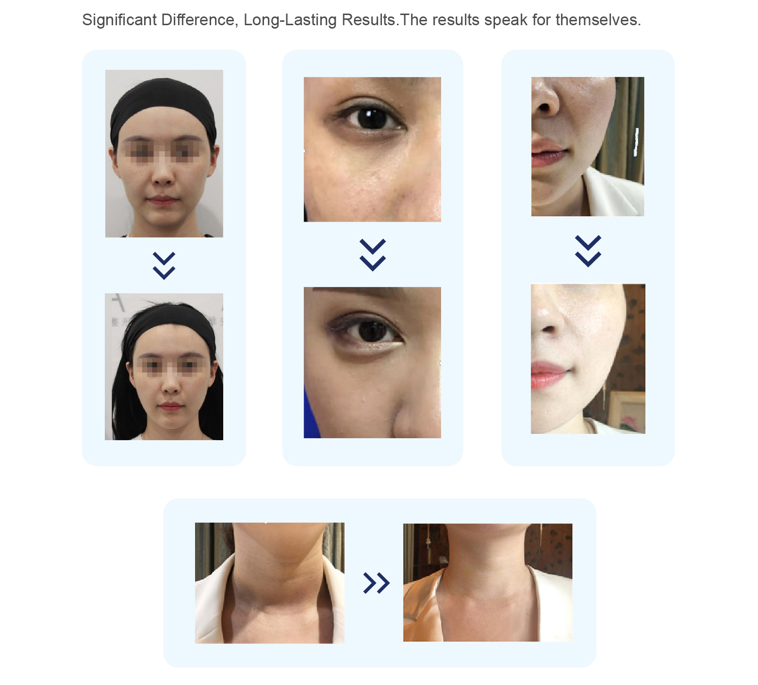 PLLA Collagen Stimulator PLLA Collagen Stimulator