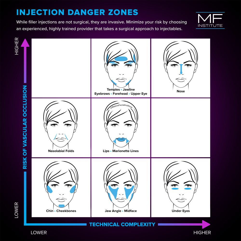 Facial Dermal Fillers Injection: Danger Zones