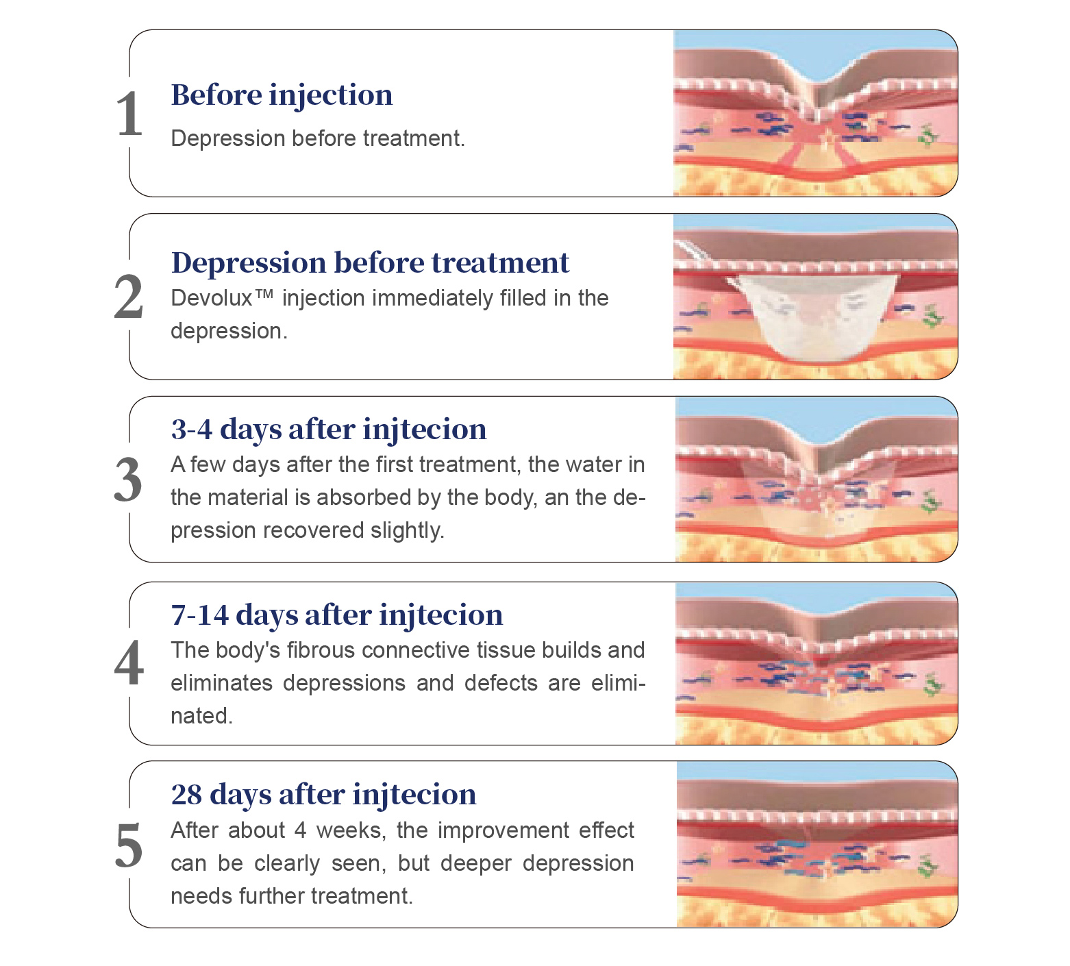 PLLA Collagen Stimulator PLLA Collagen Stimulator