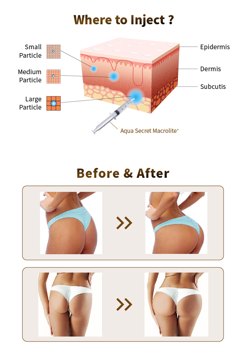 Macrolite before and after breast volumization 10 ml — professional use