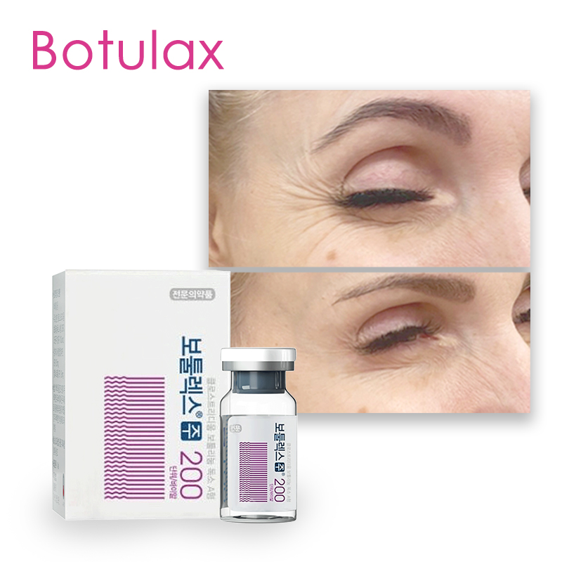 Can You Buy Botulinum Toxin over The Counter