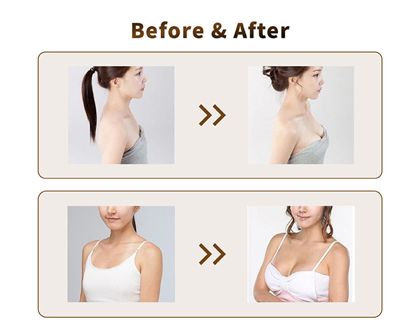 Macrolite breast filler before and after - Deramx