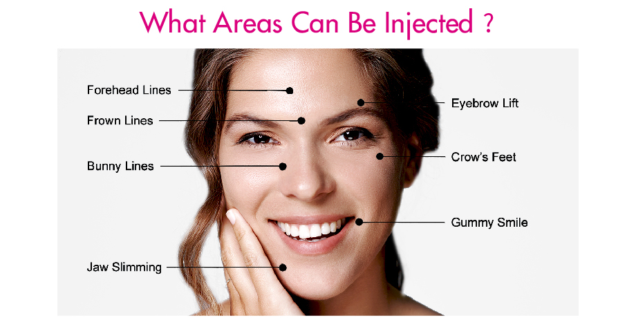 botulinum toxin injections