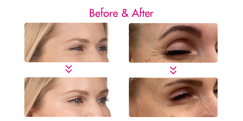 botulinum toxin type a precio before and after - Dermax