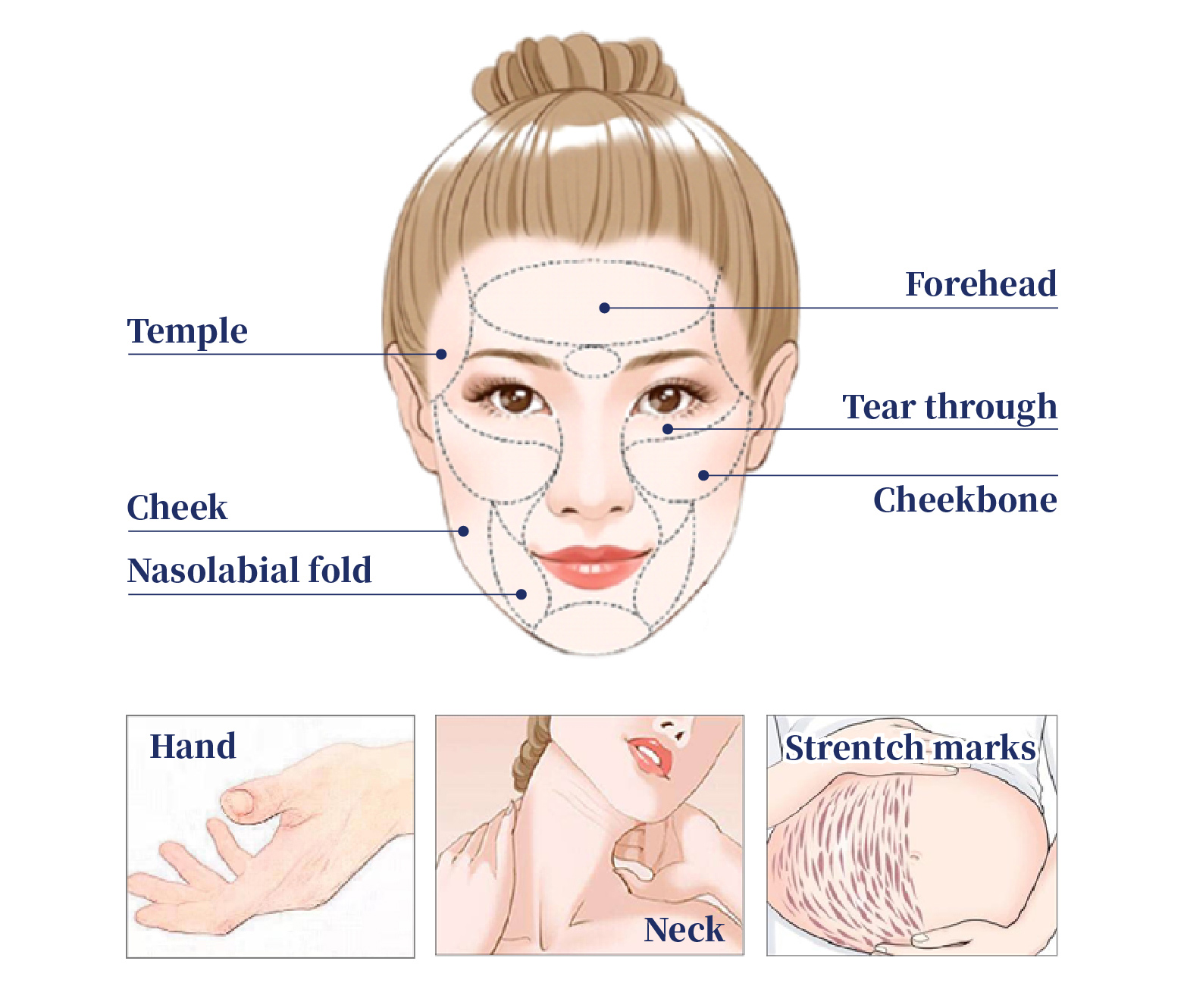 PLLA Collagen Stimulator PLLA Collagen Stimulator