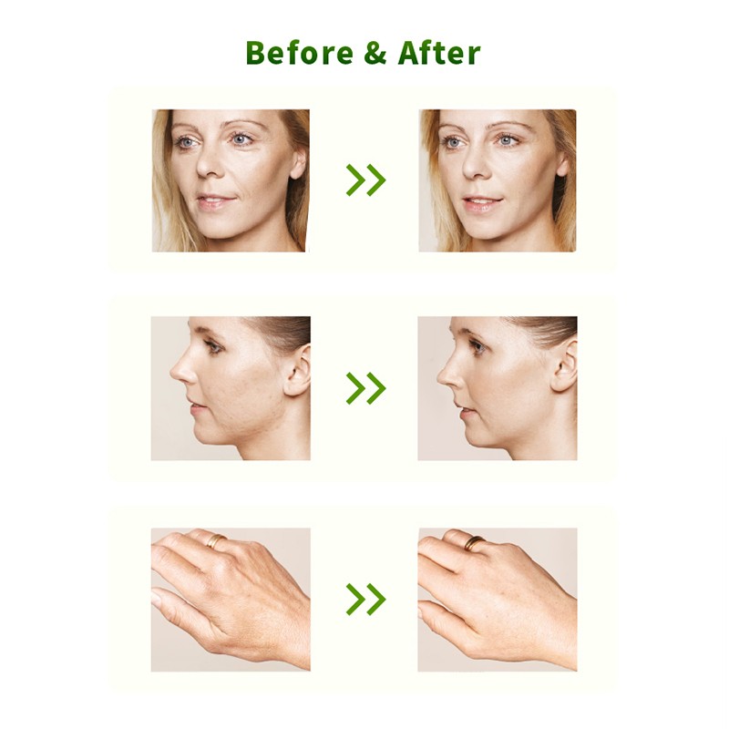 The introduction of Mesocel Skin Booster (5)