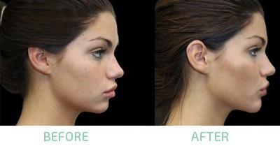chin shaping facial contours