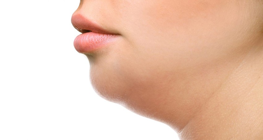What causes a double chin (2)