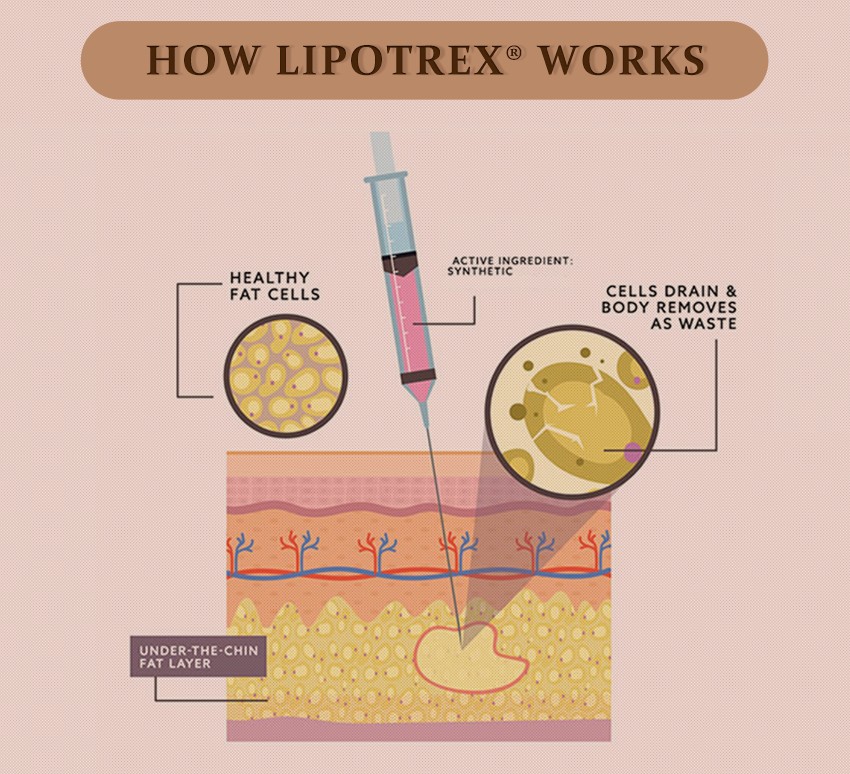 lipotropic injections for weight loss works - Dermax