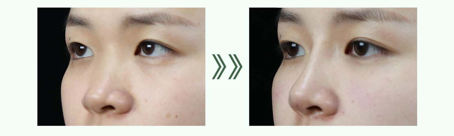 PMMA Filler Cost