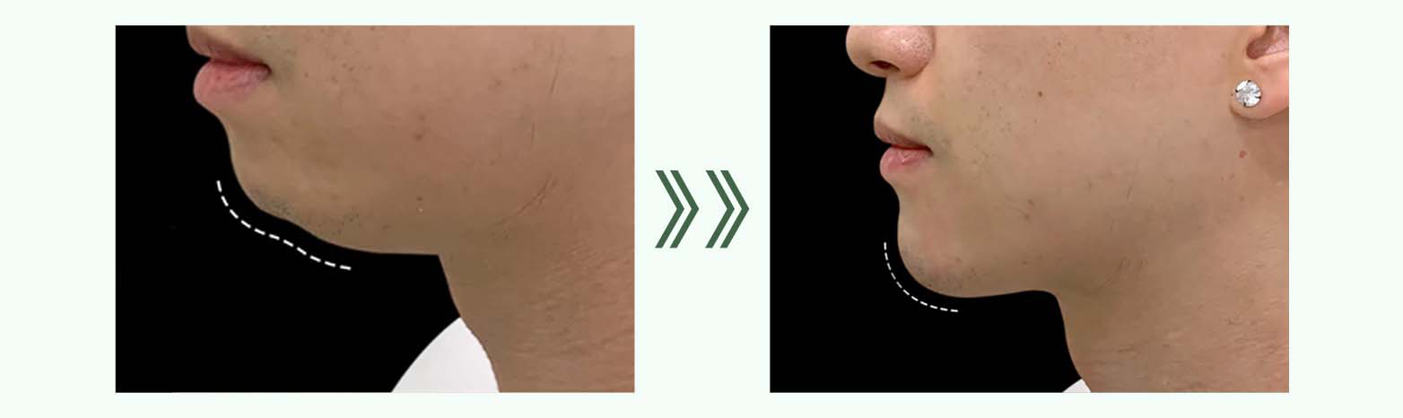 PMMA Filler Cost