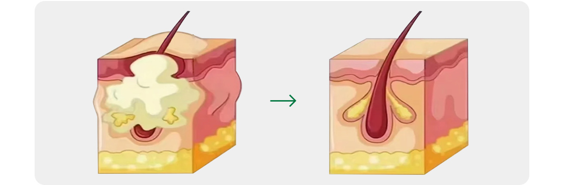 Exosomes for Hair Growth