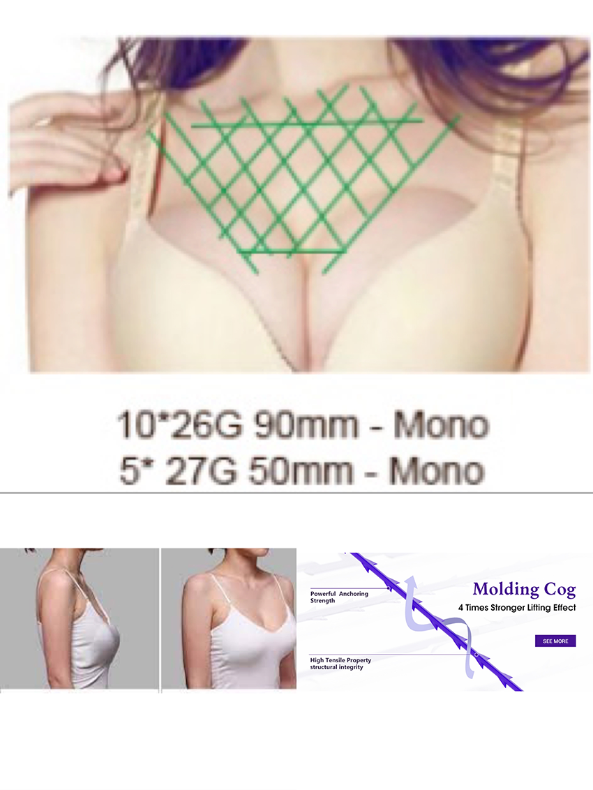 Breast lift treatment with PDO Thread