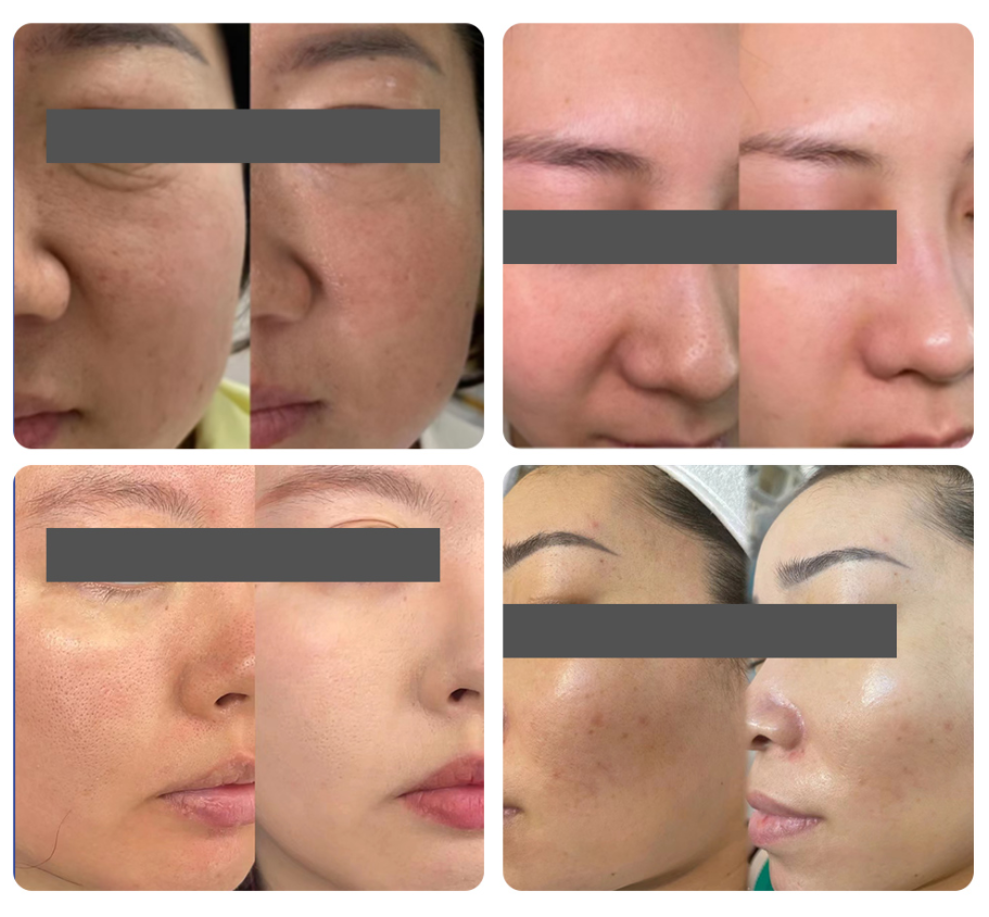 exosomes for face