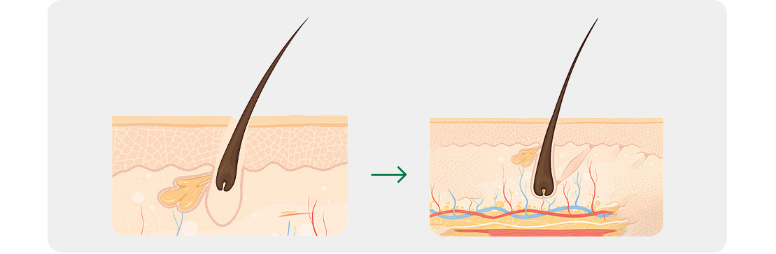 Exosomes for Hair Growth
