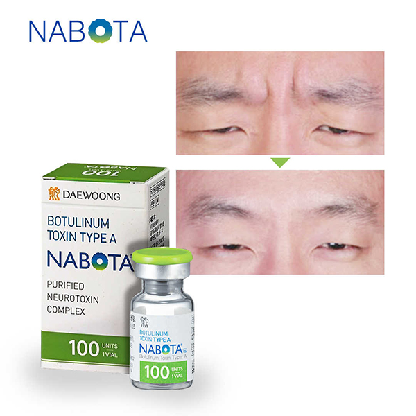  Nabota 200u Botulinum Toxin Type A