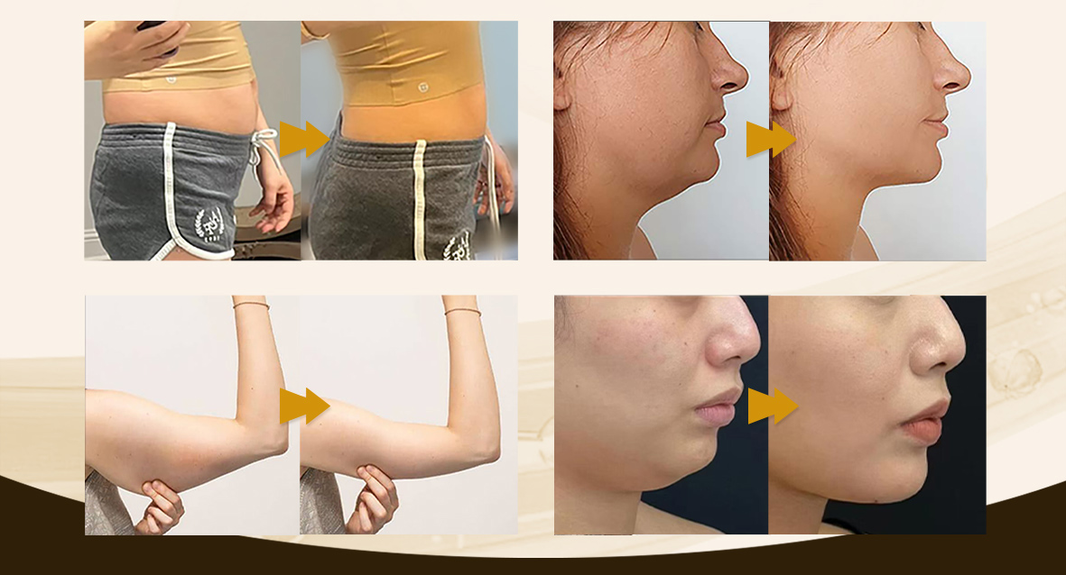 Lipolysis Injections