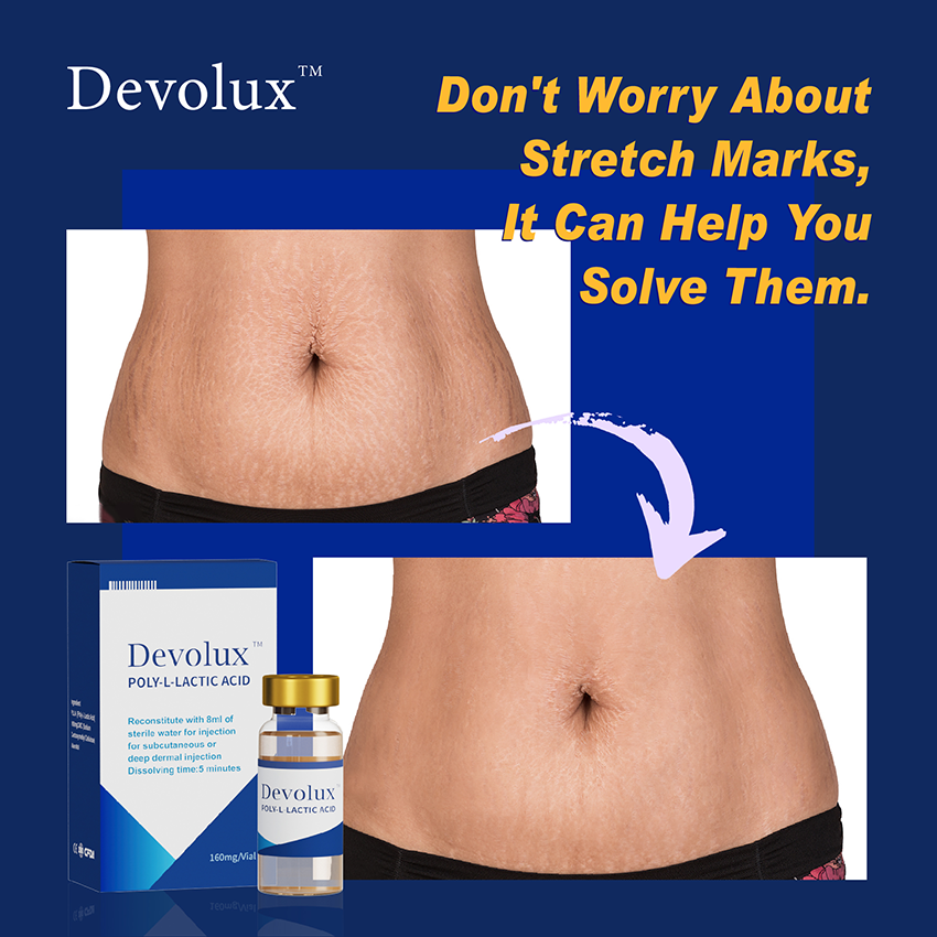 How To Beat Stretch Marks, Watch Here!