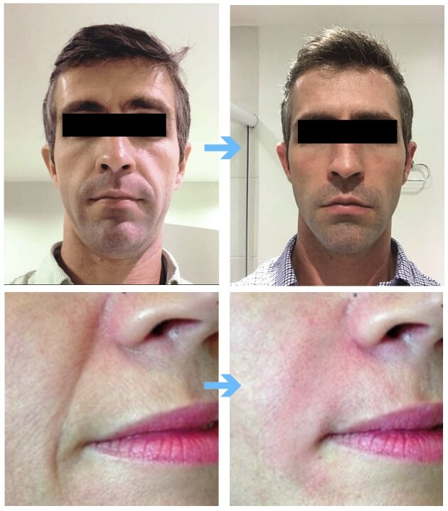 before and after of CHArmacy Filler (2)