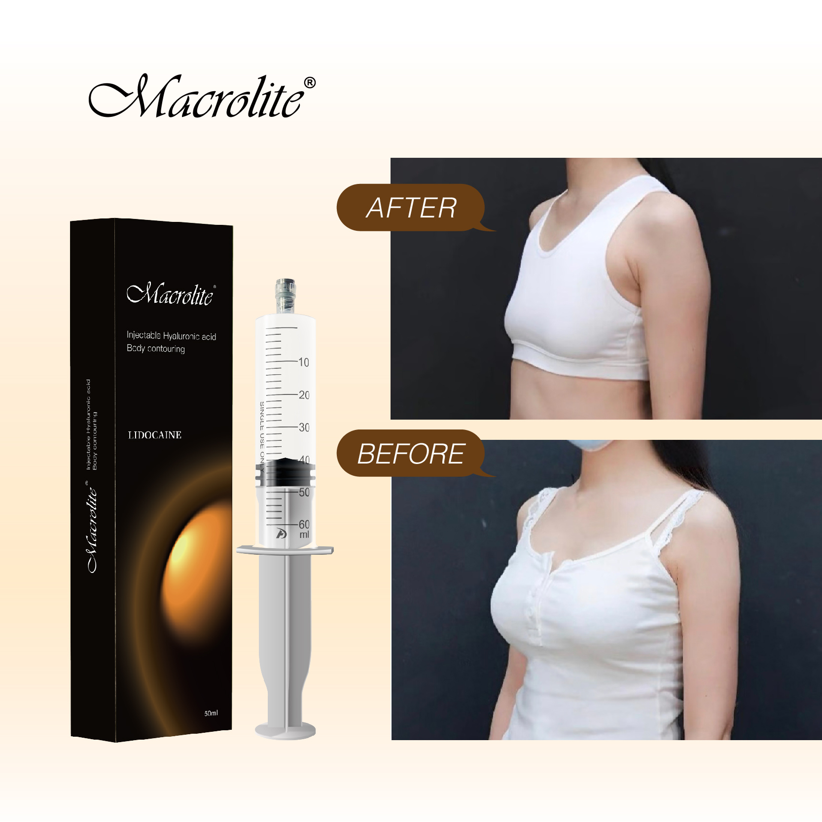 Hyaluronic Acid Breast Filler