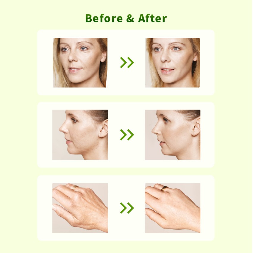 mesotherapy injections before vs after - Dermax