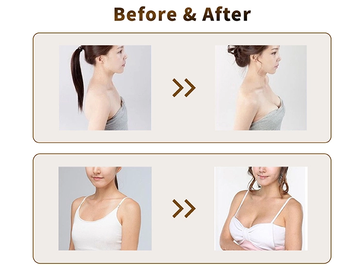 Hyaluronic Acid Breast Filler Before And After
