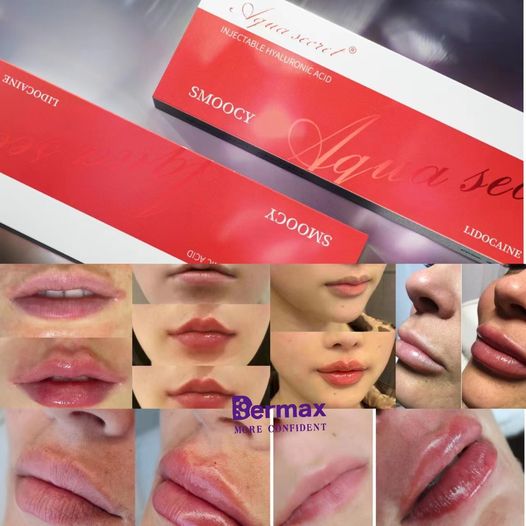 buy lip filler iniections online