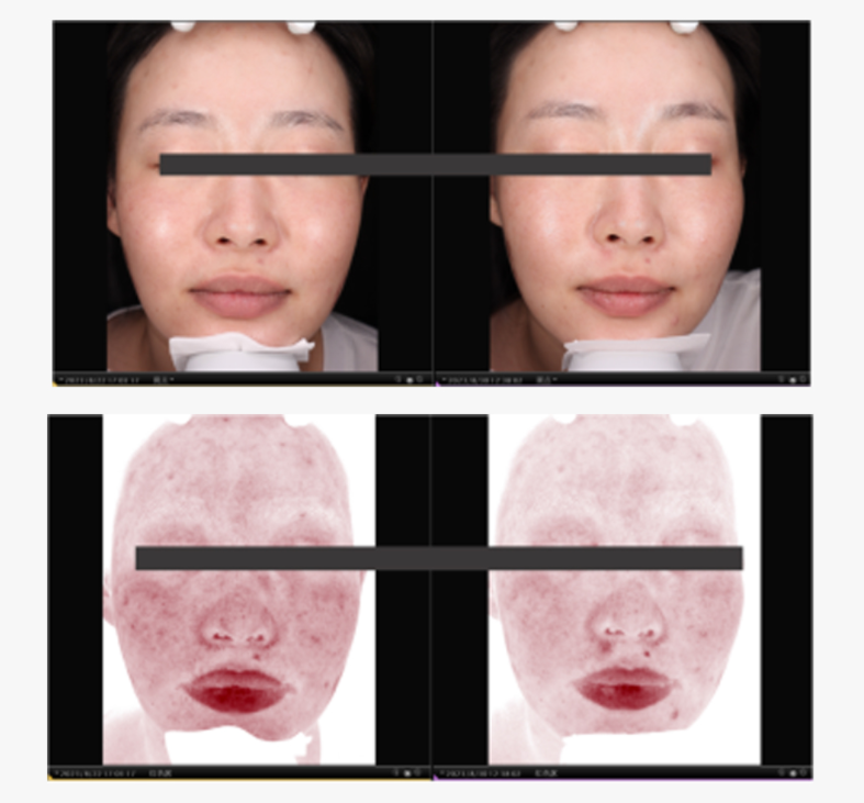 Pdrn Injection