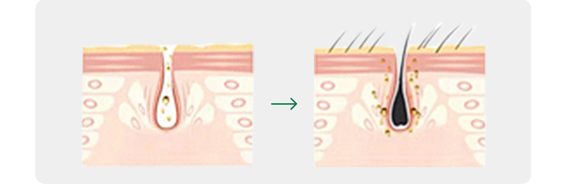 Exosomes for Hair Growth