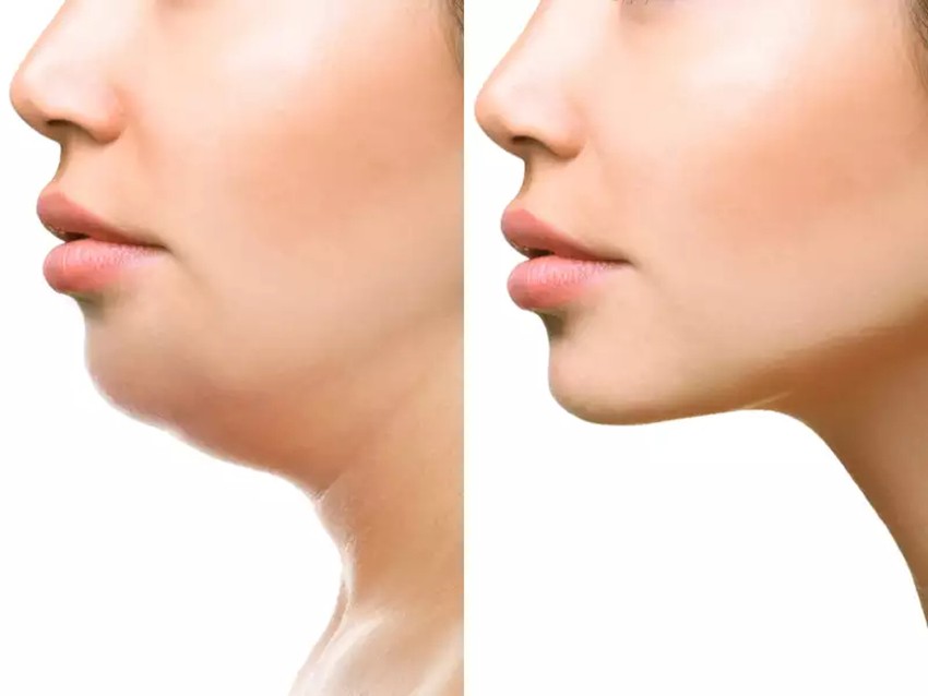 What causes a double chin (4)