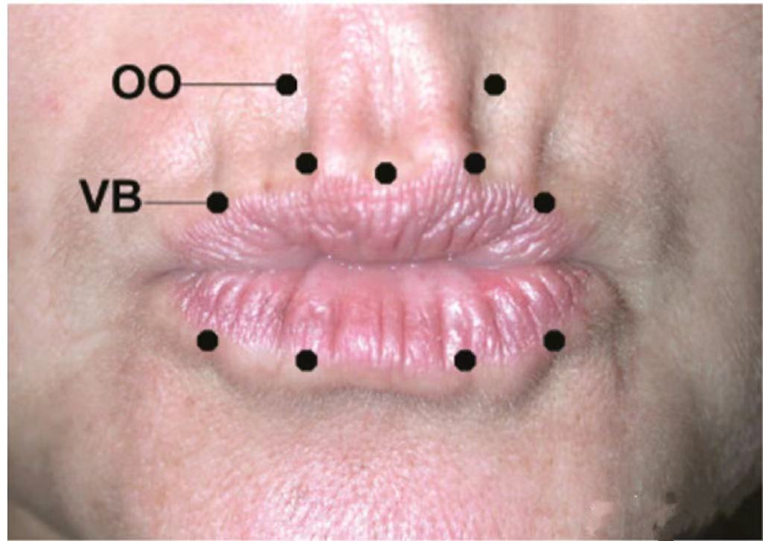 Botulinum toxin injection method for perioral lines or smoker lines