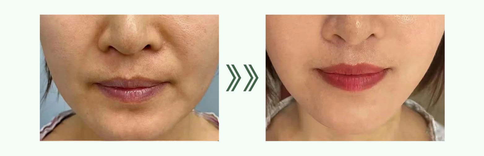PMMA Filler Cost
