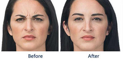 Wrinkles-between-the-eyebrows-640-640