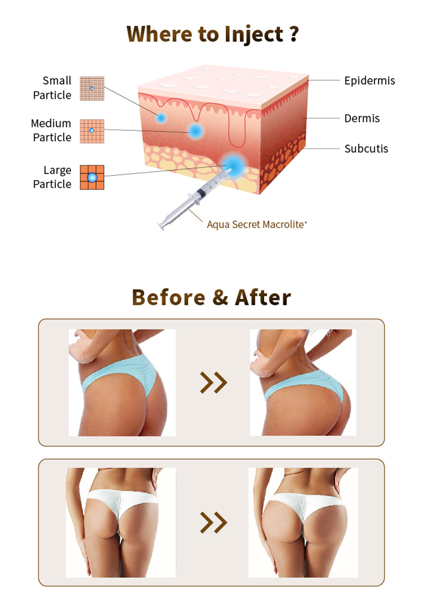 hyaluronic acid buttock injections befor and after - Dermax
