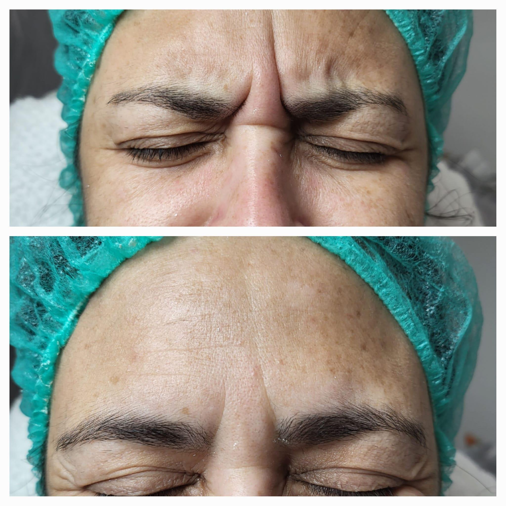 nabota botulinum toxin before and after