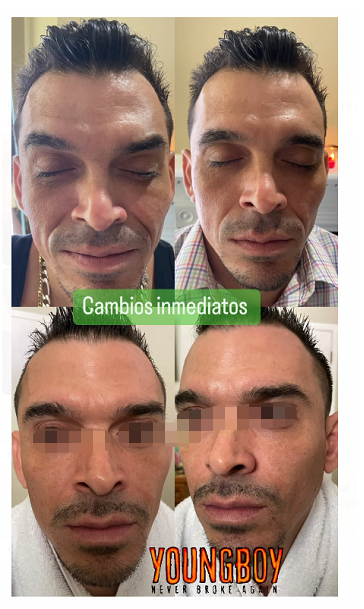 Nabota Botulinum Toxin Review