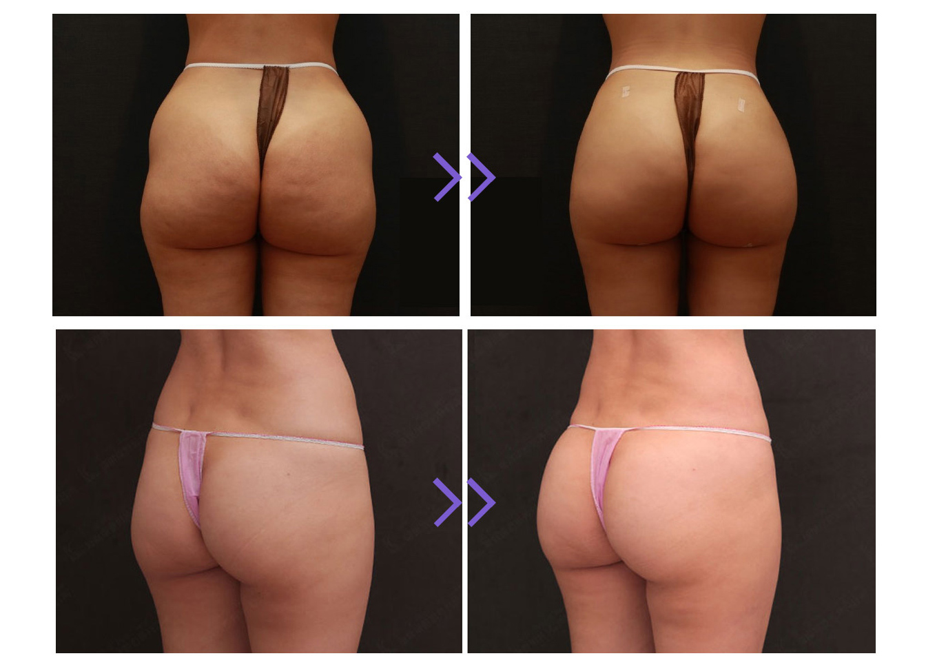 Plla Buttock Injections