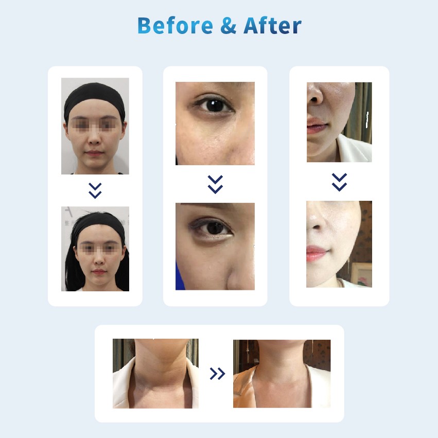 Injectable Poly L Lactic Acid before after - Dermax