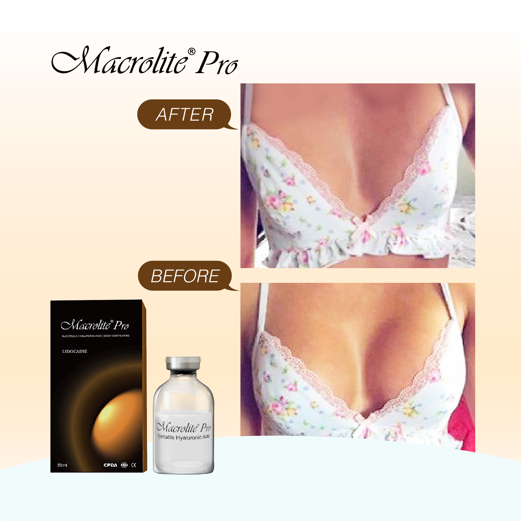 Hyaluronic Acid Breast Filler