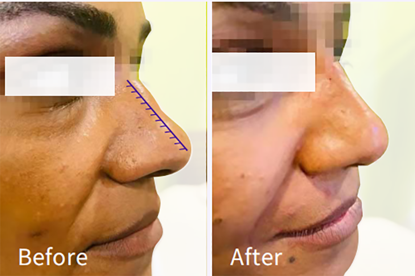 Perfect nose shape without surgery - Magik Thread