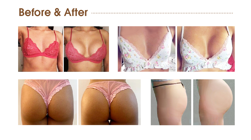 Breast augmentation with dermal fillers