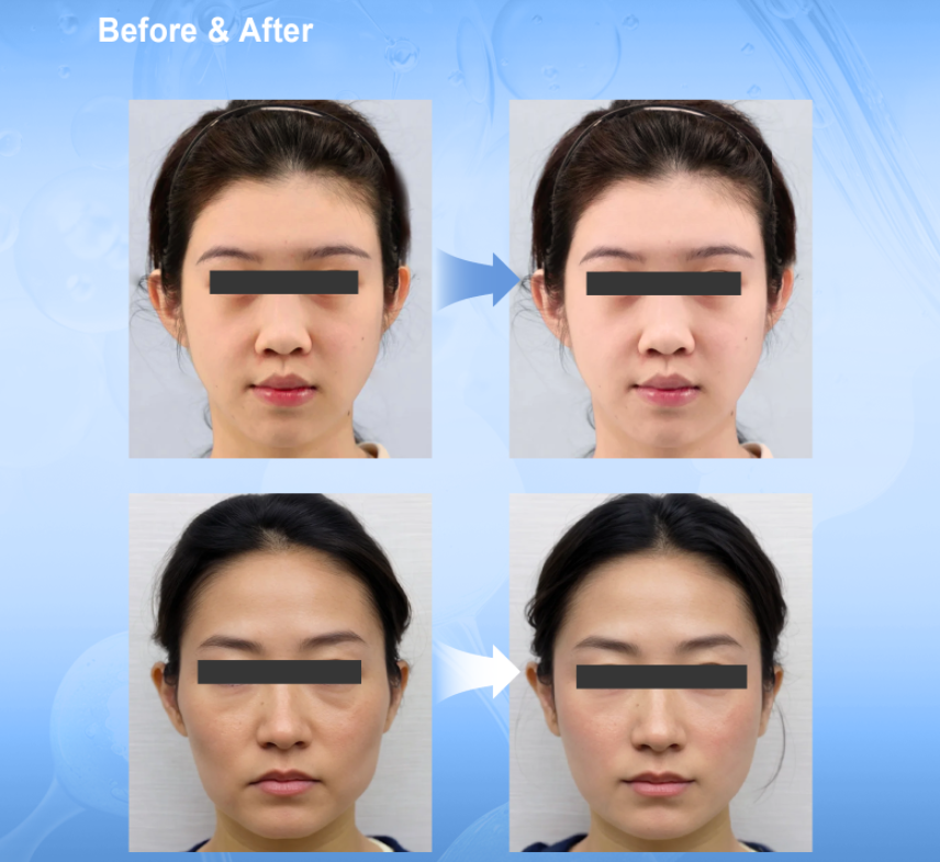 Hyaluronic Acid for Microneedling