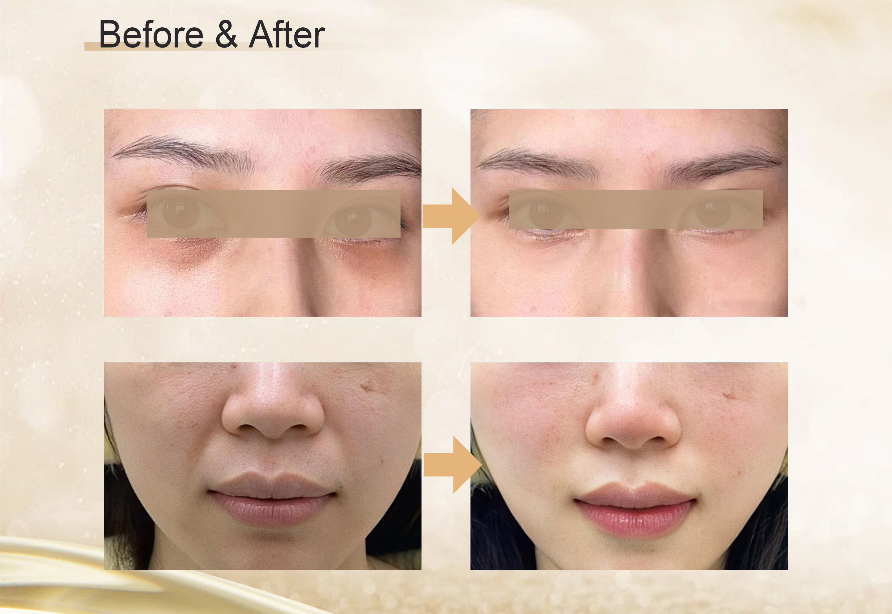 Collagen Implant